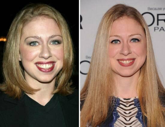 Chelsea Clinton Plastic Surgery Pictures