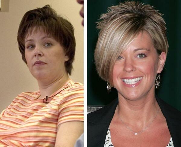 Kate Gosselin plastic surgery before and after