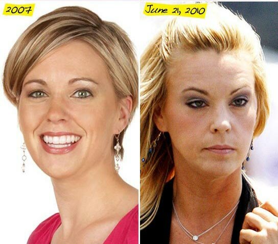 Kate Gosselin plastic surgery