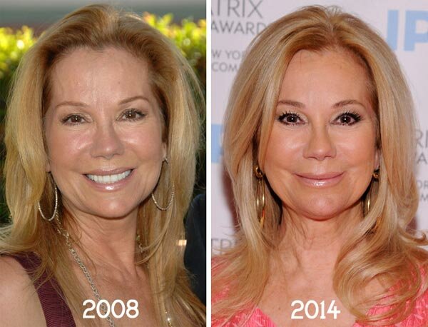 Kathie Lee Gifford plastic surgery