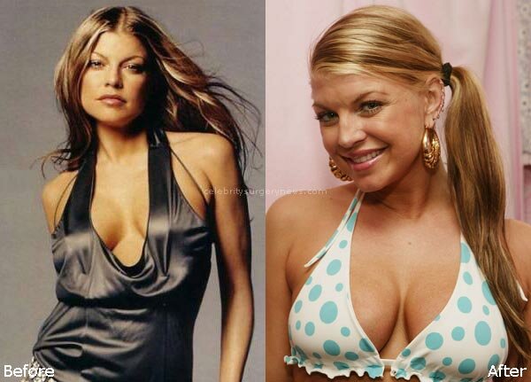 Fergie boob job