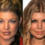 Fergie Plastic Surgery Before and After