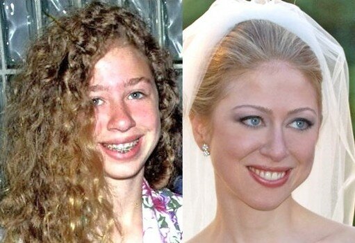 Chelsea Clinton Braces