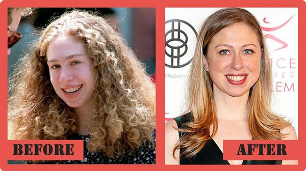 Chelsea Clinton Plastic Surgery Before After
