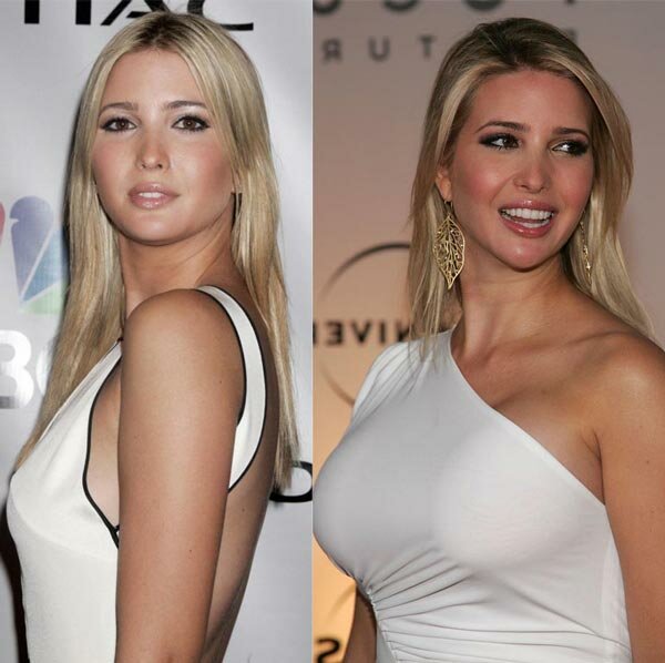 Ivanka Trump Breast Implants