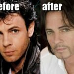 Rick Springfield Plastic Surgery Before & After Photos