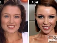 Dannii Minogue plastic surgery