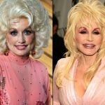 Dolly Parton Plastic Surgery Before and After