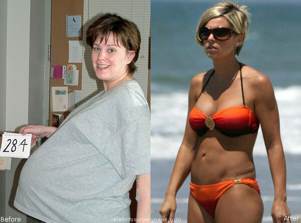 Kate Gosselin tummy tuck before and after