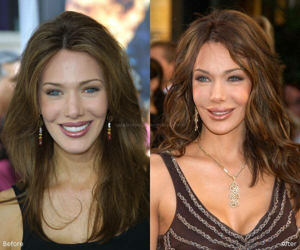 Hunter Tylo plastic surgery photos