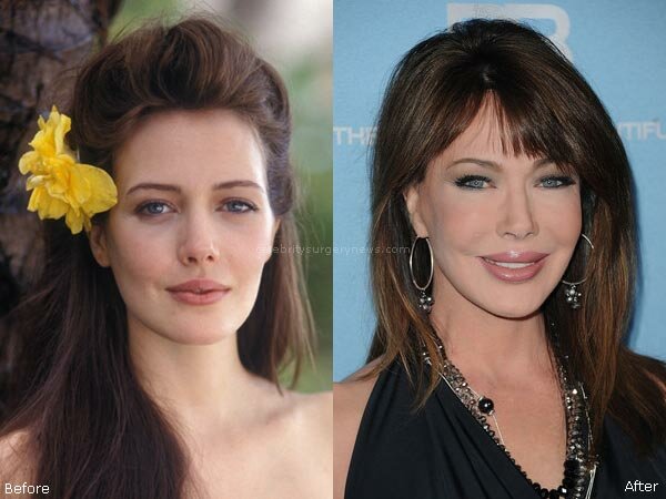 Hunter Tylo plastic surgery