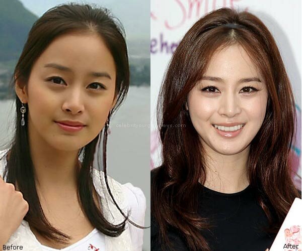 Kim Tae Hee plastic surgery