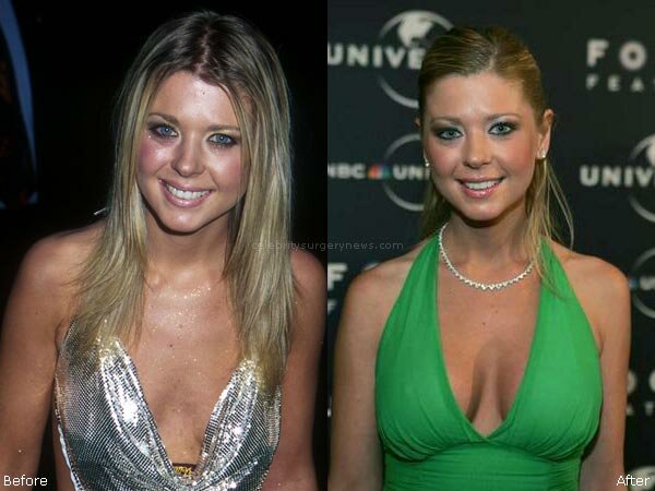 Tara Reid boob job