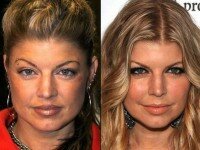 Fergie Plastic Surgery before and after