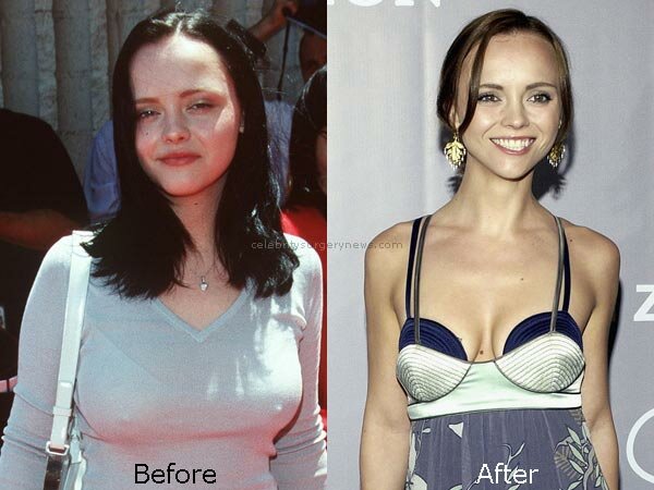 Christina Ricci breast reduction before and after