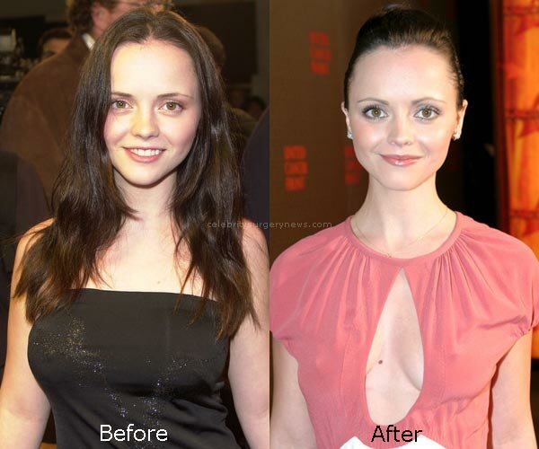 Christina Ricci Breast Reduction