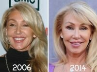 Linda Thompson plastic surgery