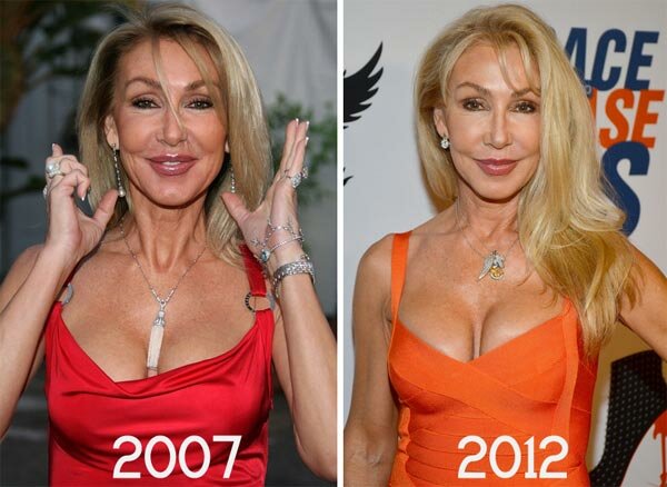 Linda Thompson plastic surgery before and after