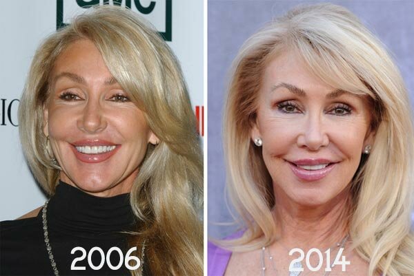 Linda Thompson plastic surgery